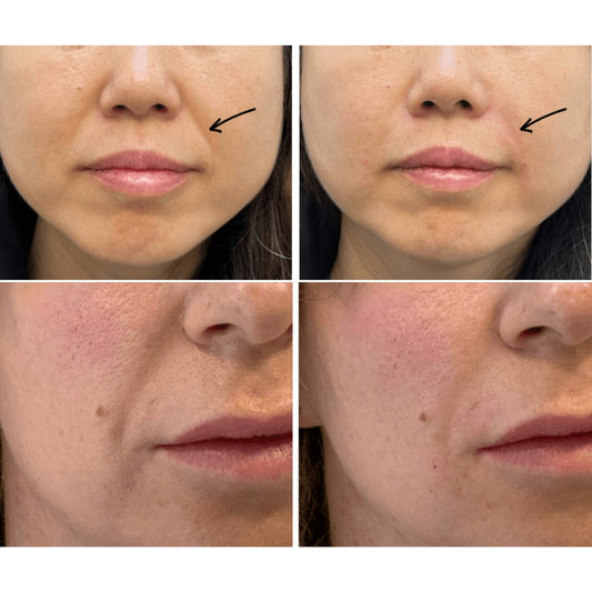 Before and after comparison of facial skin with black arrows pointing to blemishes.