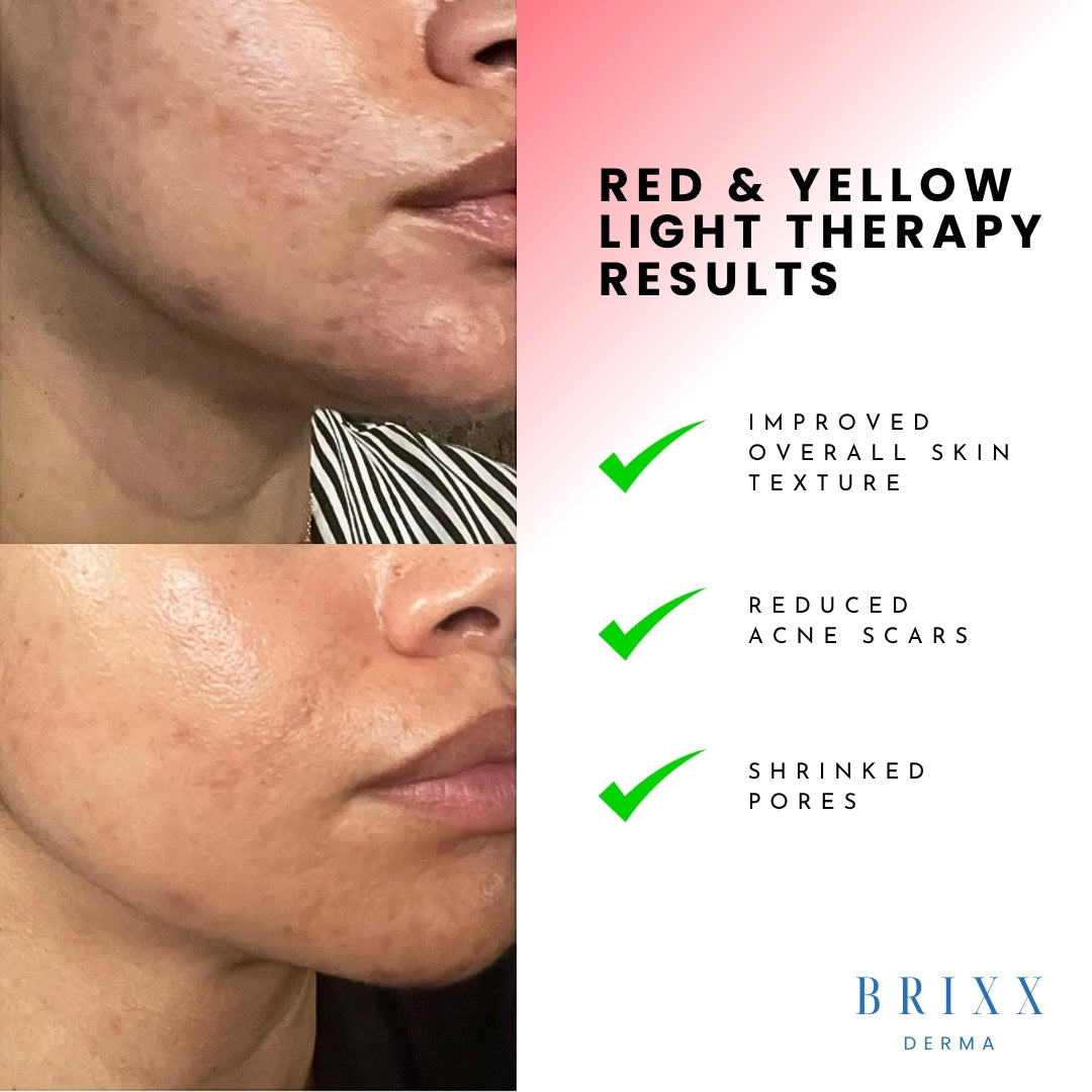 Before and after effects of red and yellow light therapy on skin with BRIXX DERMA branding.