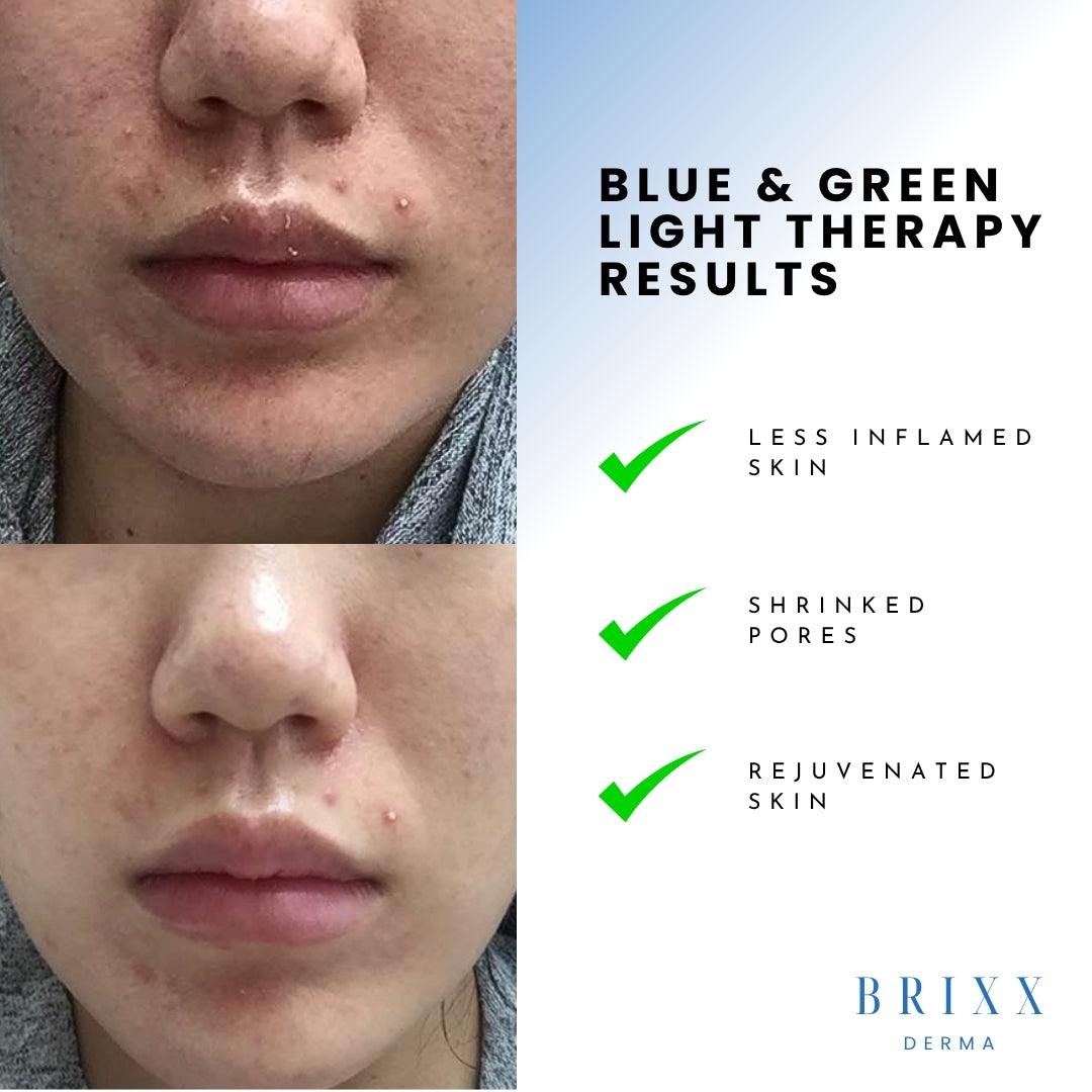Before and after comparison of skin treatment with blue and green light therapy, showing less inflamed skin, shrunk pores, and rejuvenated skin. Brand 'Brixx Derma' is visible.