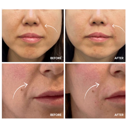 LumiLift Pro Face Lift Device
