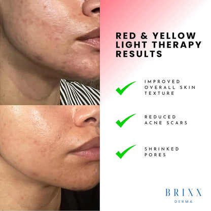 Before and after effects of red and yellow light therapy on skin with BRIXX DERMA branding.